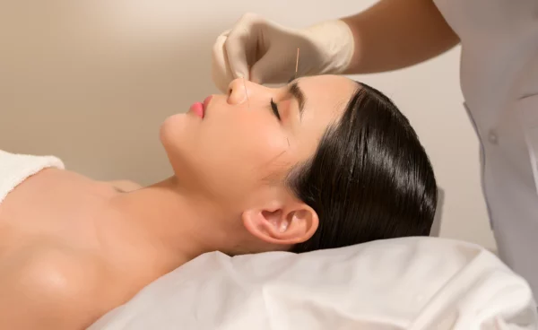 akupunktura medycyna naturalna